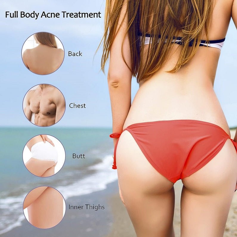 Tobcharm Butt & Back Acne Treatment Cream w/ Azelaic Acid - bodytonix