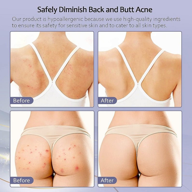 Tobcharm Butt & Back Acne Treatment Cream w/ Azelaic Acid - bodytonix