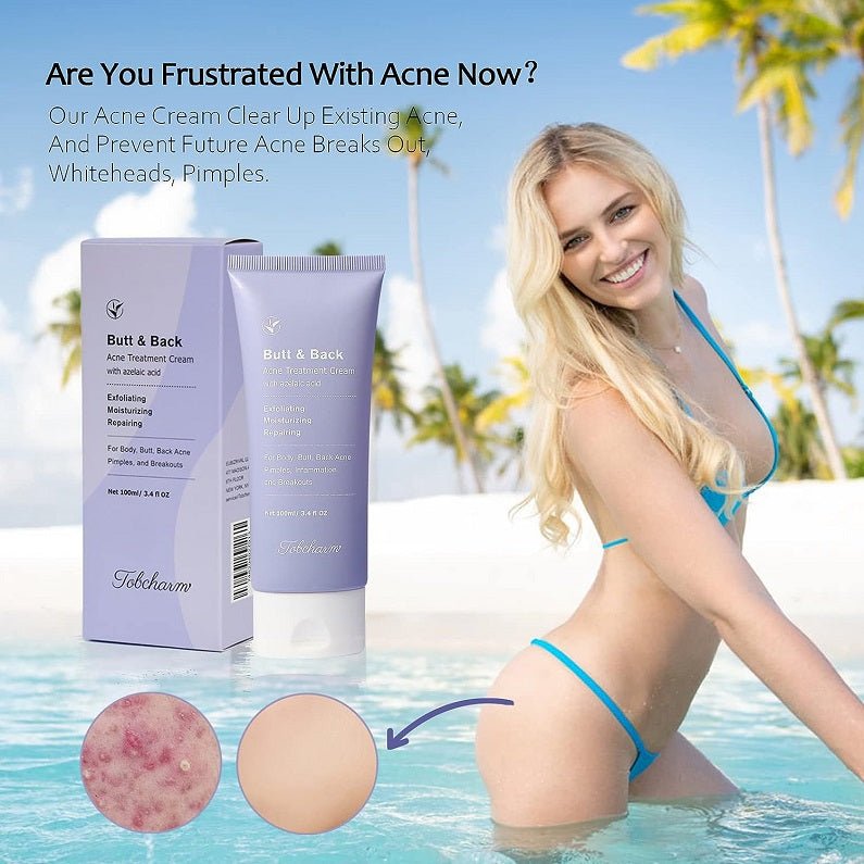 Tobcharm Butt & Back Acne Treatment Cream w/ Azelaic Acid - bodytonix