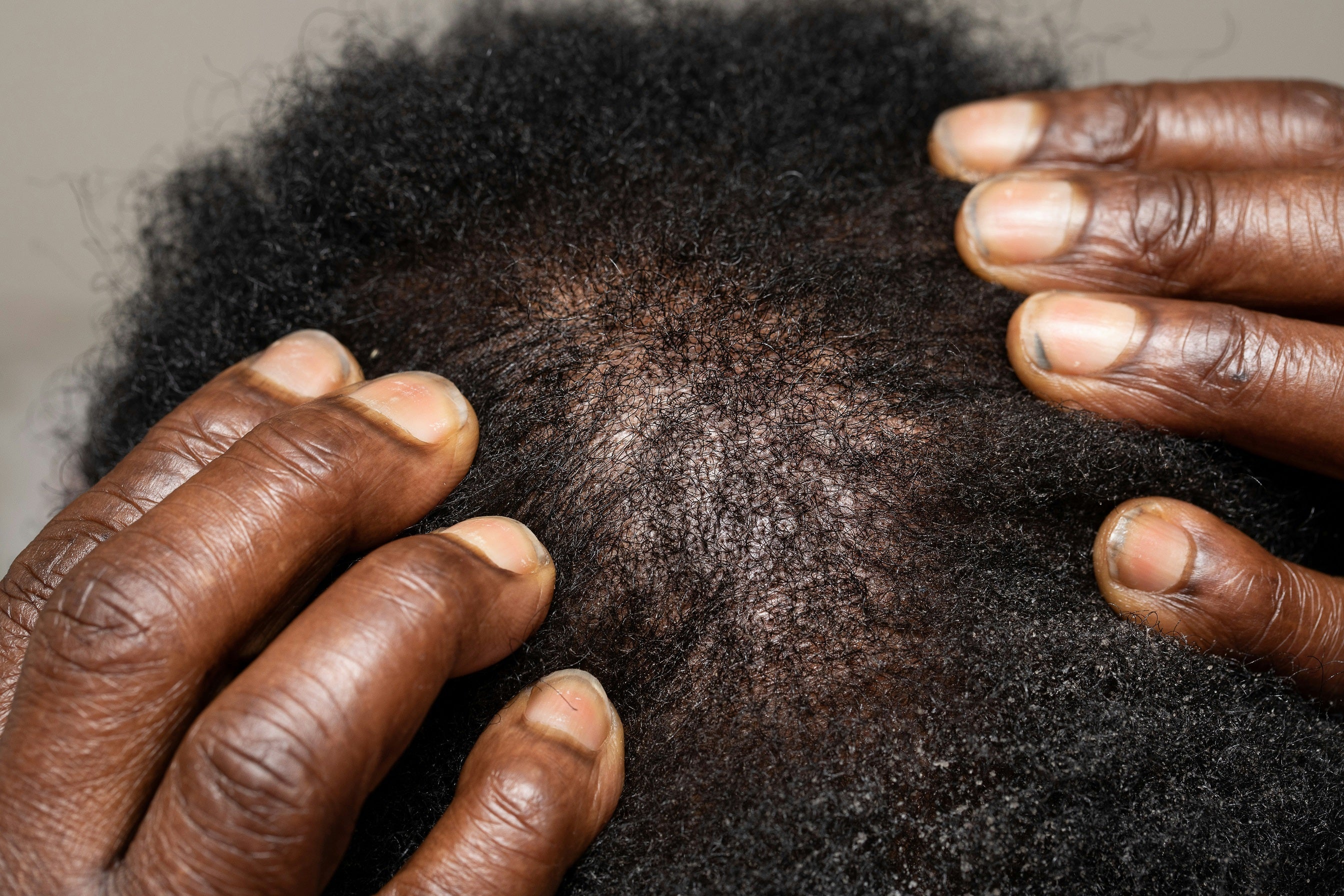 DHT Blockers for Hair Loss: How They Work, Benefits & Side Effects
