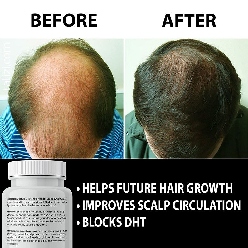 FINANUTRIDE natural DHT blocker bottle with help future hair growth bullet points
