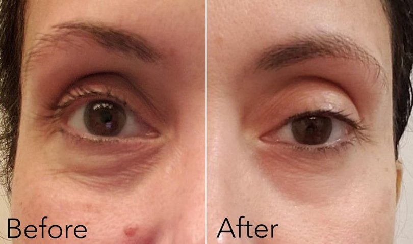 Under-eye before-and-after on face, showing brighter under-eye area.
