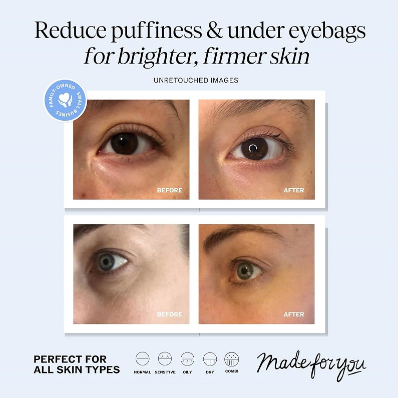 Under-eye before-and-after photos showing reduced puffiness and under-eye bags