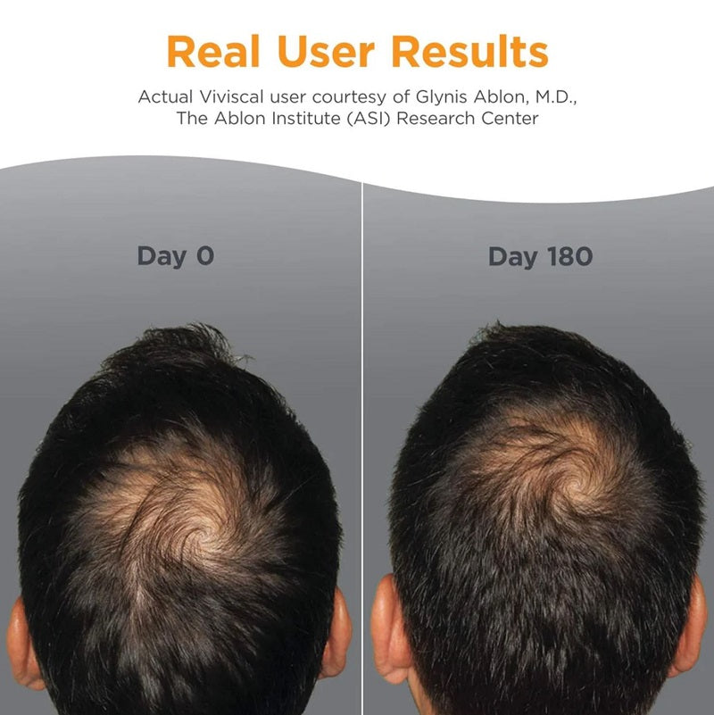 Thinning scalp comparison, Day 0 vs Day 180