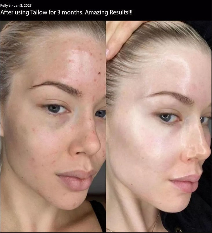 Whipped tallow cream results on face: before and after side-by-side skin close-up