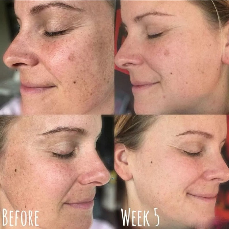 Skin whitening before-and-week 5 facial results showing clearer complexion
