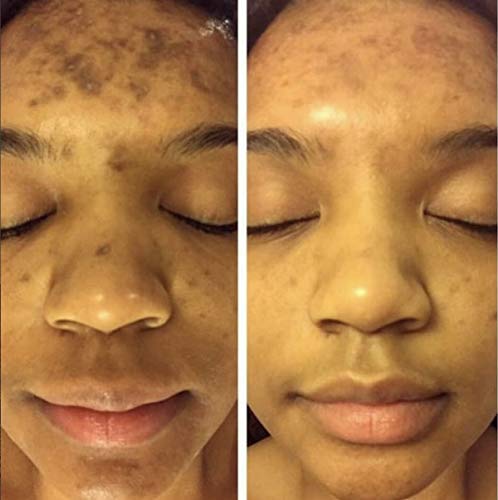 Face close-up with brighter, more even complexion after skincare