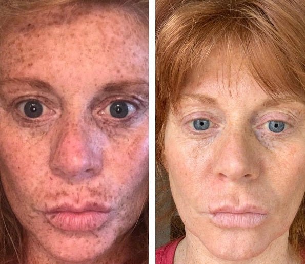 Face close-up showing lighter, more even skin tone after treatment