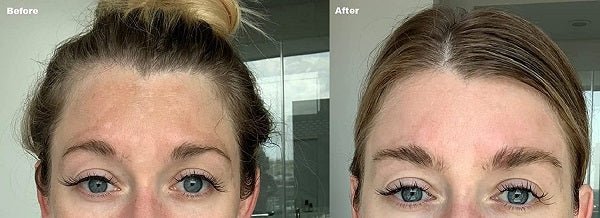 Close-up of woman’s face, showing clearer under-eye skin after treatment