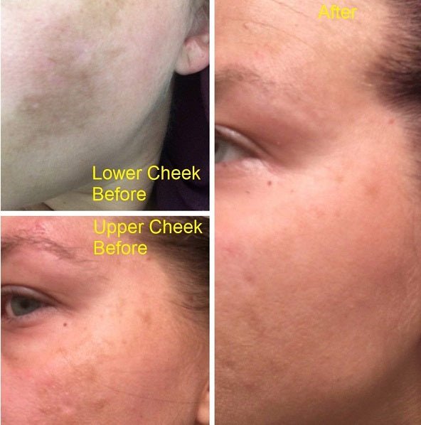 Cheek and jaw skin area close-ups with reduced redness after use