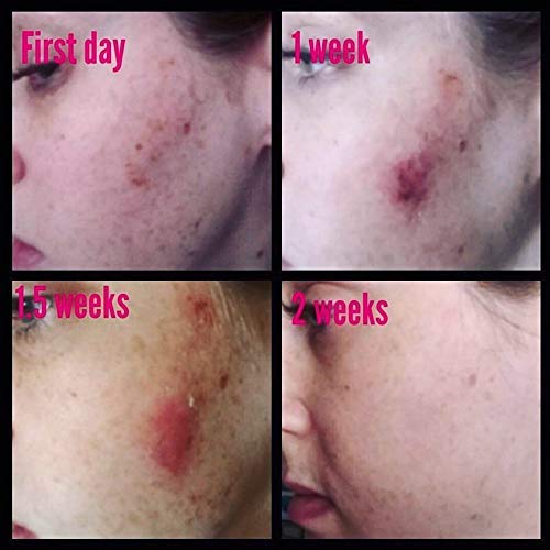 Neck and shoulder skin close-ups showing fewer dark patches over time