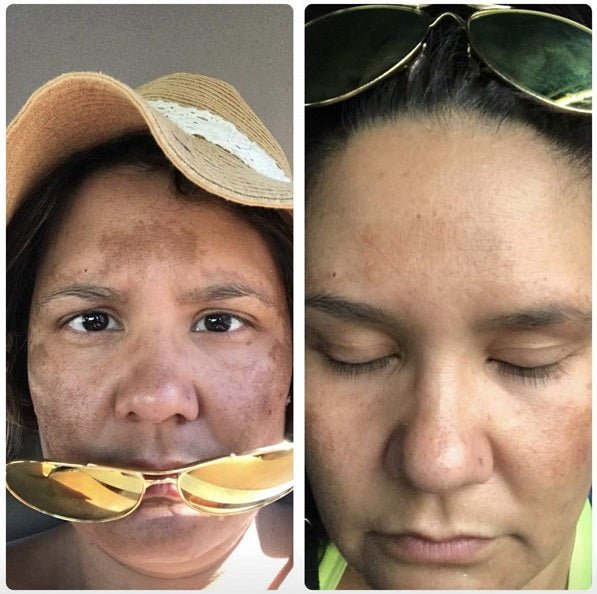 Before-and-after face close-up with reduced dark spots and redness on skin