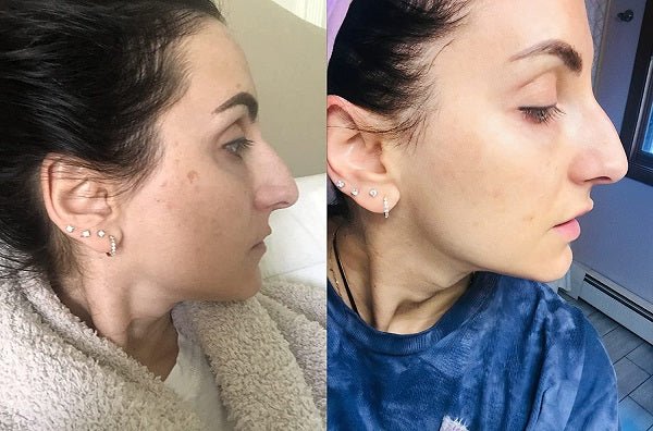 Woman’s side profile close-up with smoother cheek skin after treatment