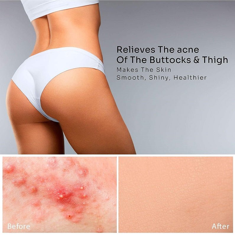 Butt and thigh area in underwear with before-and-after acne closeups