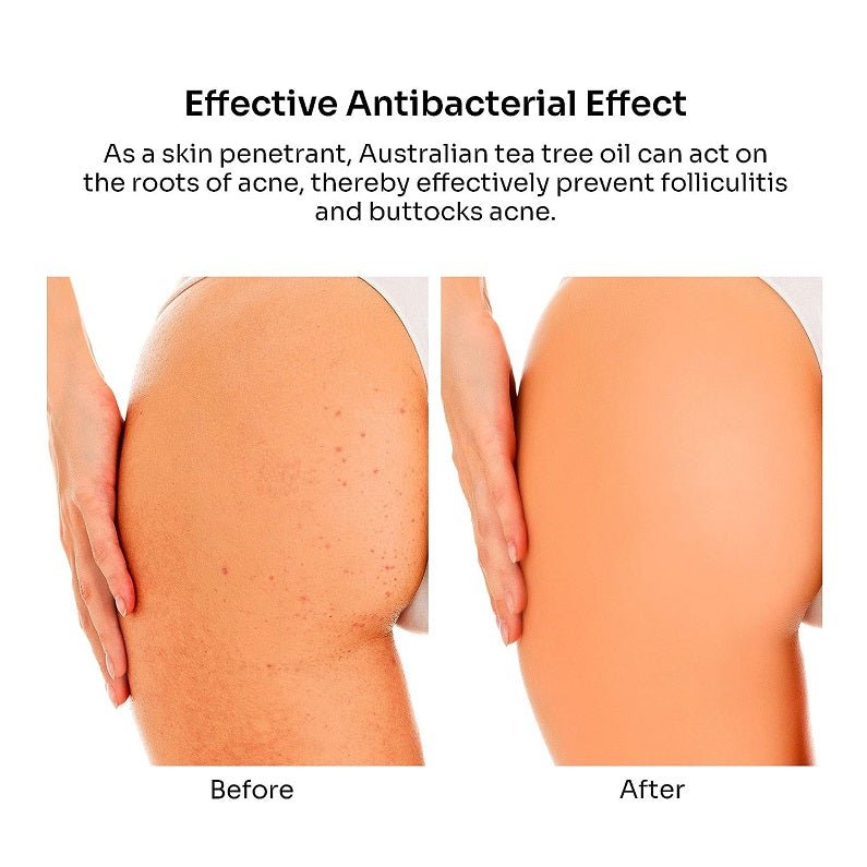 Buttocks before-and-after comparison showing clearer skin after acne treatment