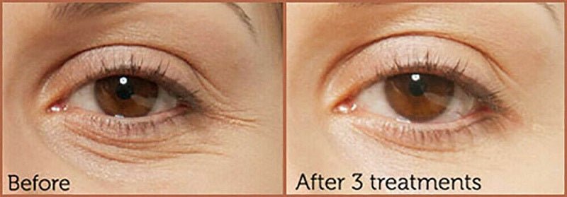 Eyelid close-up before and after treatments for a smoother appearance