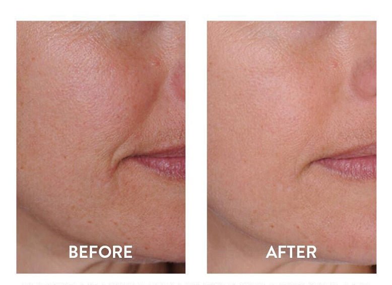 Before and after facial skin close-up with smoother, more even-looking texture