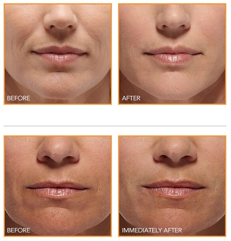 Four-panel before and after lip and chin skin results, including immediately after