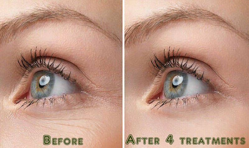 Eye-area before and after showing reduced fine lines after treatments