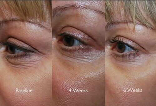 Eye-area skin before and after at baseline, 4 weeks, and 6 weeks