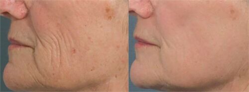 Before and after lower face skin comparison, side view with smile line visible