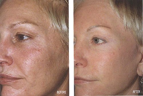 Before and after side-by-side face skin comparison, wrinkles and texture visible
