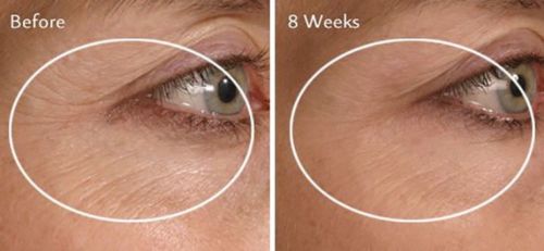 Before and after eye-area skin comparison with circular highlights