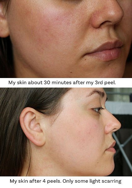 Two close-up side views of facial skin showing before-and-after peel results