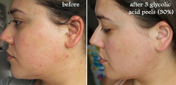 Side-by-side cheek close-ups showing skin before and after glycolic peel
