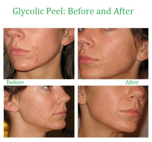Before-and-after facial skin collage with side profiles and split comparison frames