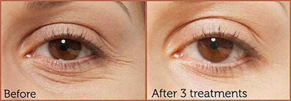Face eye-area split view: before and after, smoother-looking under-eye skin