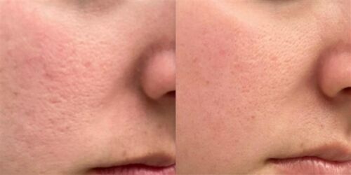 Split cheek and nose close-up showing skin texture before and after