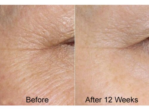 Skincare before-and-after on cheek, split view showing improved skin texture
