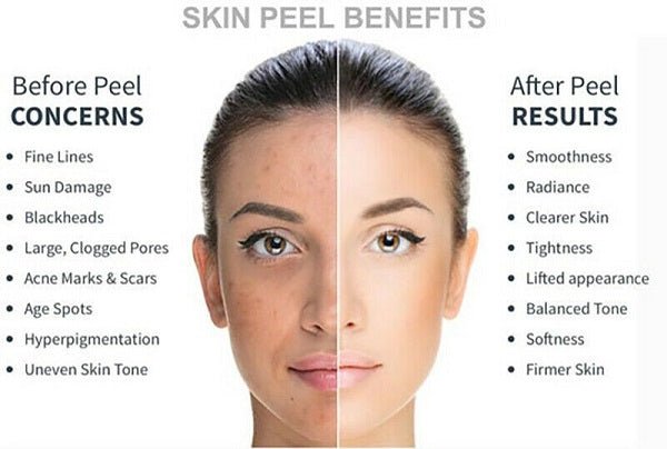 Woman face with before-and-after skin peel benefits diagram showing concerns and results