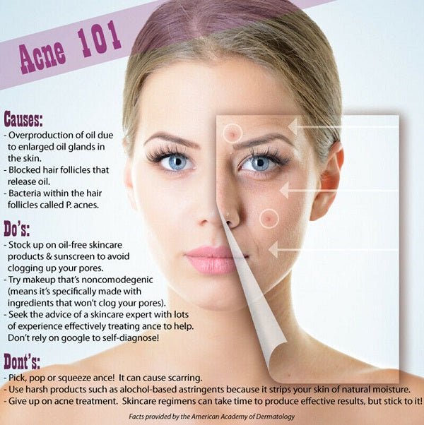 Woman face with acne guide graphic overlay and arrows for treatment steps