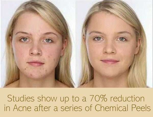 Before-and-after portraits of a woman showing clearer, smoother facial skin
