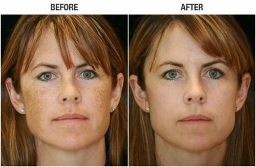 Side-by-side before and after facial skin peel results on a woman's face