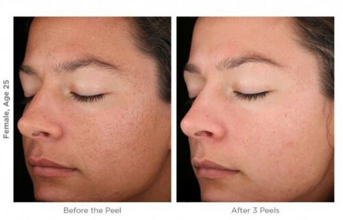 Microdermabrasion exfoliating cream before-and-after side face photo