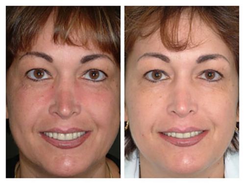 Microdermabrasion exfoliating cream before-and-after face photo, frontal view