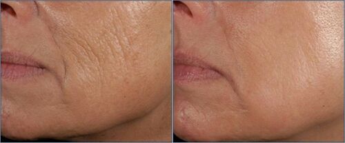 Wrinkle repair moisturizer results: side-by-side close-up of facial skin texture