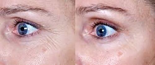 Wrinkle repair moisturizer results: side-by-side close-up of eyes and forehead
