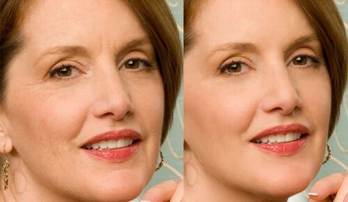 Wrinkle repair moisturizer results: side-by-side face close-up with smoother skin