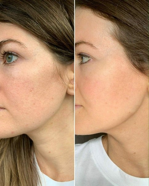 Retinol moisturizer before-and-after face skin close-up, left vs right view