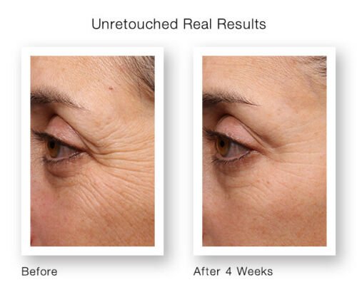 Retinol moisturizer results panel with before and after skin close-ups