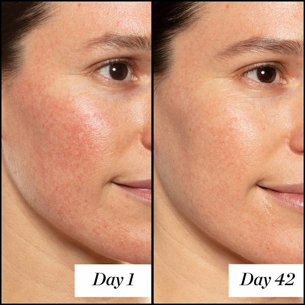 Retinol moisturizer day 1 vs day 42 facial close-up, left and right halves