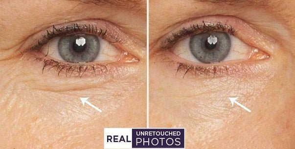 Split-eye close-up showing eye area before and after retinol serum