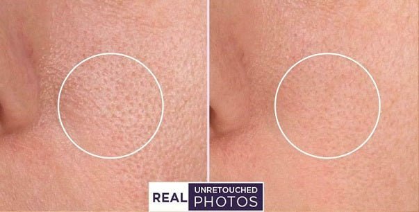 Split-face photo showing skin before and after retinol treatment