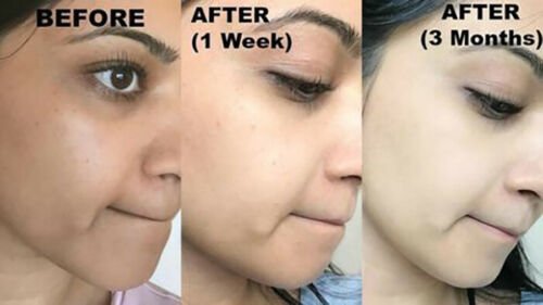 Before-and-after results on face labeled 1 week and 3 months