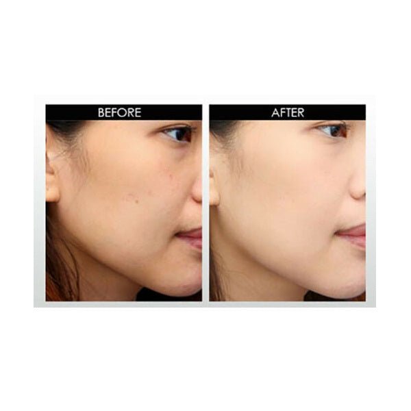 Before-and-after facial skin results with two side-by-side views, left before right after.