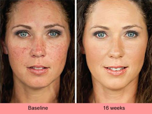 Before-and-after portrait showing brighter skin at 16 weeks